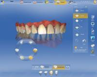 CEREC AC OMNICAM ПРОСТОЕ СКАНИРОВАНИЕ БЕЗ АНТИБЛИКОВОГО СПРЕЯ 15.jpg