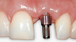 PROPHYflex4_Subgingival-implantat_700.jpg PROPHYflex4_Subgingival-implantat_700.jpg