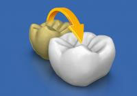 CEREC AC OMNICAM ПРОСТОЕ СКАНИРОВАНИЕ БЕЗ АНТИБЛИКОВОГО СПРЕЯ 17.jpg