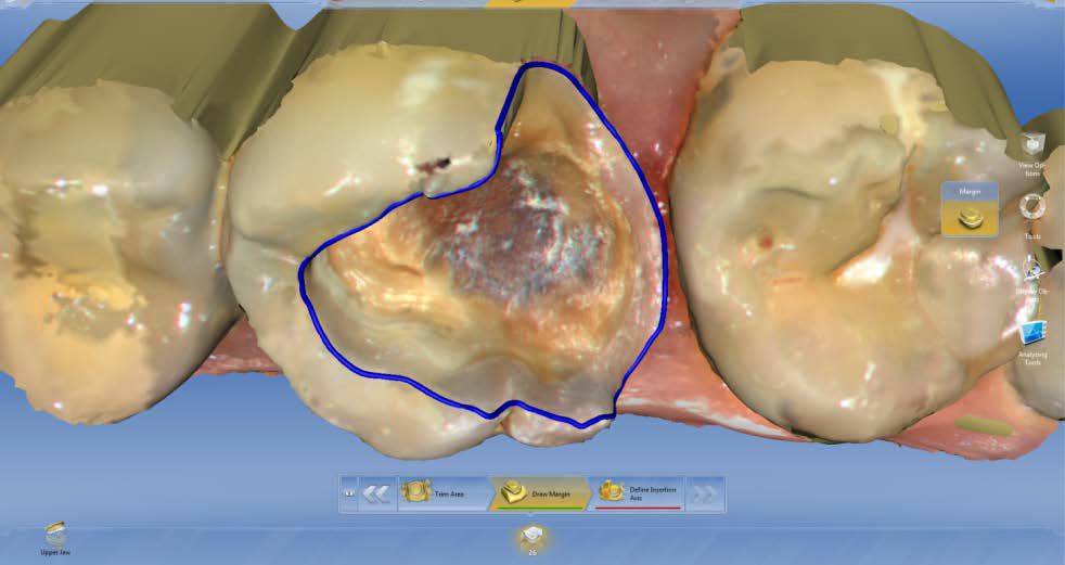 CEREC AC OMNICAM ПРОСТОЕ СКАНИРОВАНИЕ БЕЗ АНТИБЛИКОВОГО СПРЕЯ 5.jpg