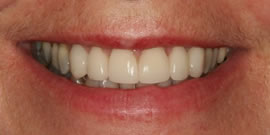 CEREC AC OMNICAM ПРОСТОЕ СКАНИРОВАНИЕ БЕЗ АНТИБЛИКОВОГО СПРЕЯ 23.jpg