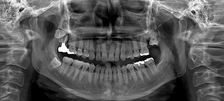Ray RAYSCAN Alpha P – ортопантомограф