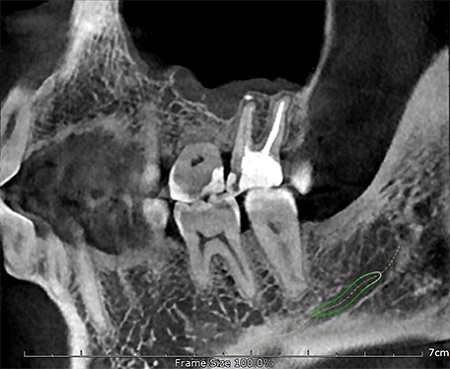 GENORAY Papaya 3D Plus 16x8 - компьютерный томограф с цефалостатом